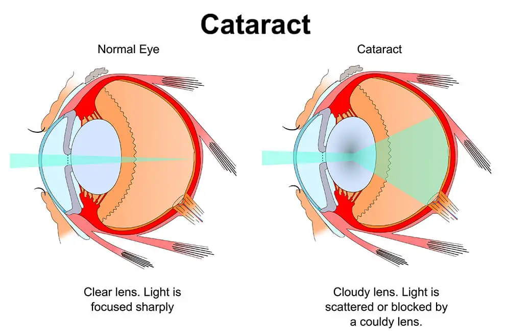 Cataracts Surgery