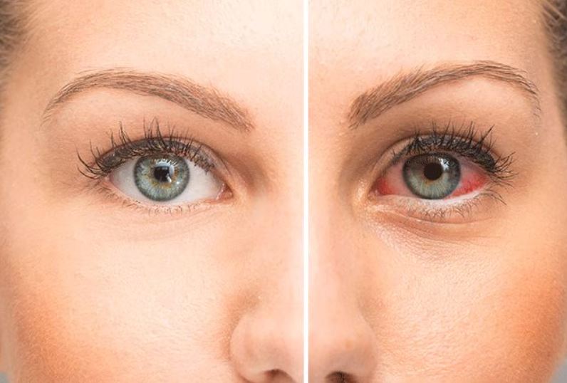 Dry Eye Syndrome
