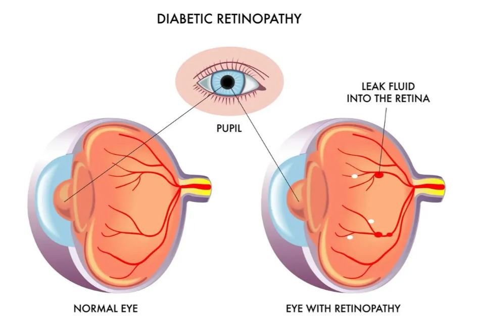 Diabetic-Retinopathy
