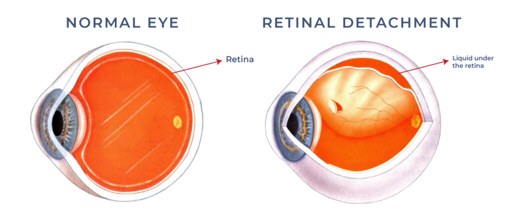 Retinal Detachment