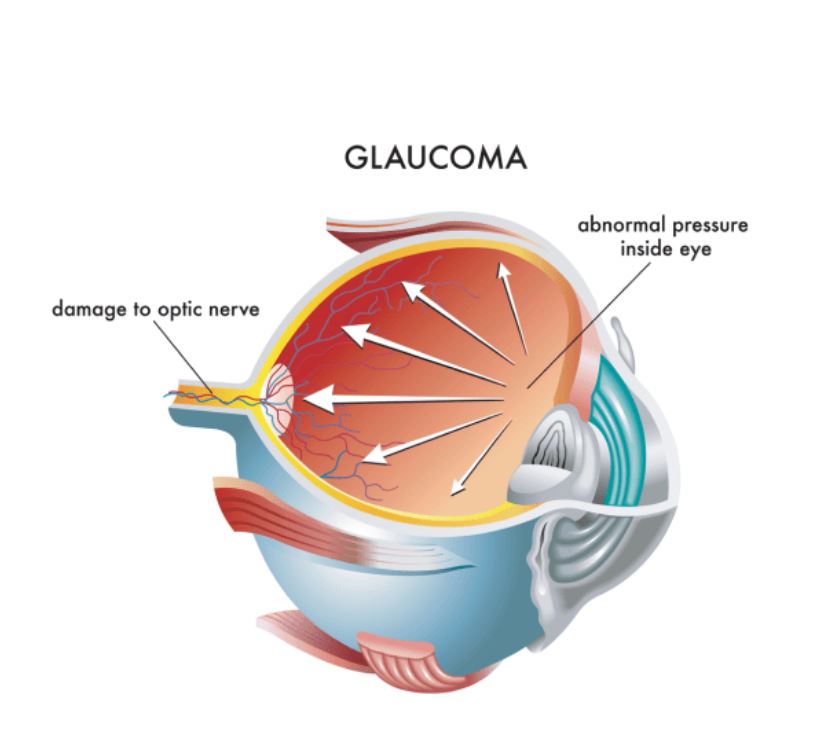 Glaucoma Eye diseases