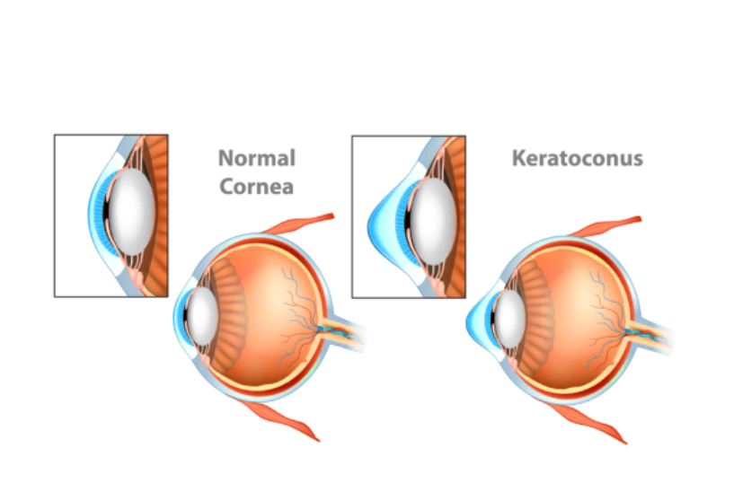 Keratoconus Eye Diseases