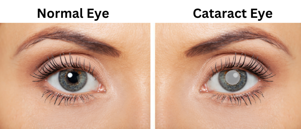 Cataract Eye Image