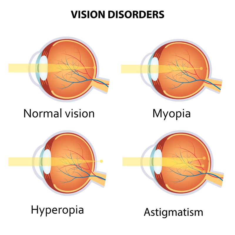 Refractive Errors