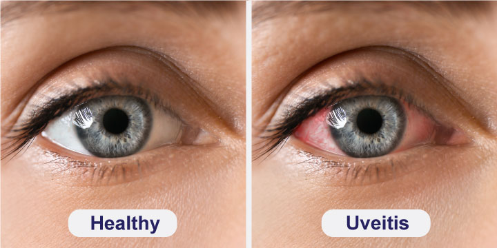 Uveitis Eye Symptoms