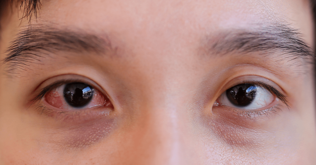 Conjunctivitis (Pink Eye)