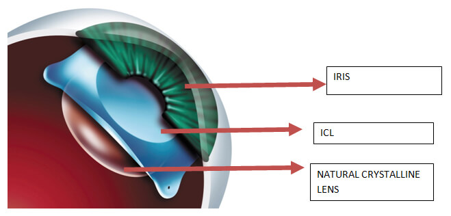 ICL Implantation - Dr. Chameen Sams