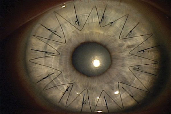 Laser Eye