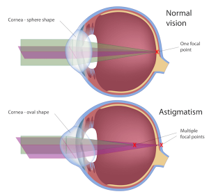 Normal Vision - Astigmatism