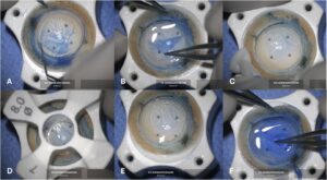 Novel Trephine for Descemet Membrane Endothelial Keratoplasty Surgery Improves Surgical