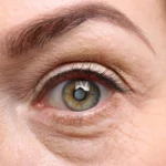 A Closer Look at Cataracts