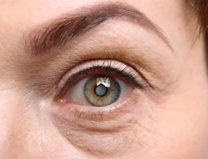 A Closer Look at Cataracts