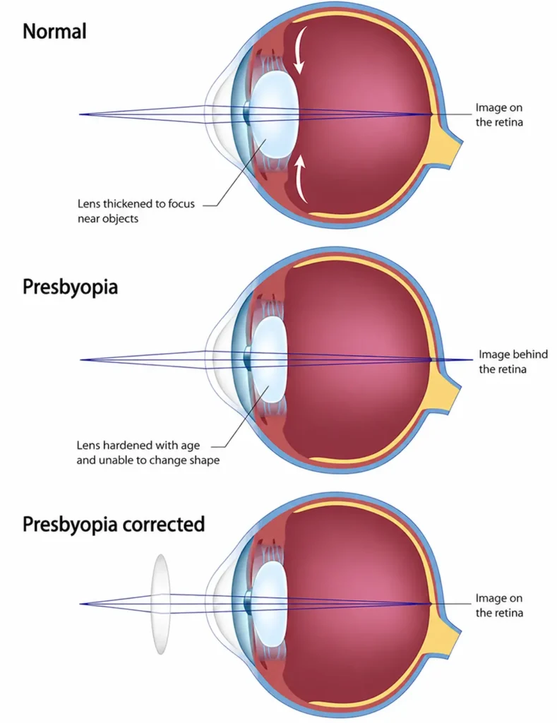 Normal Vision VS Presbyopia